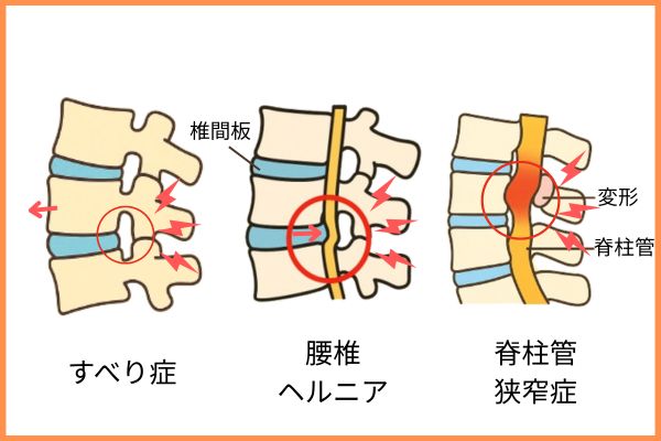すべり症　腰ヘルニア違い